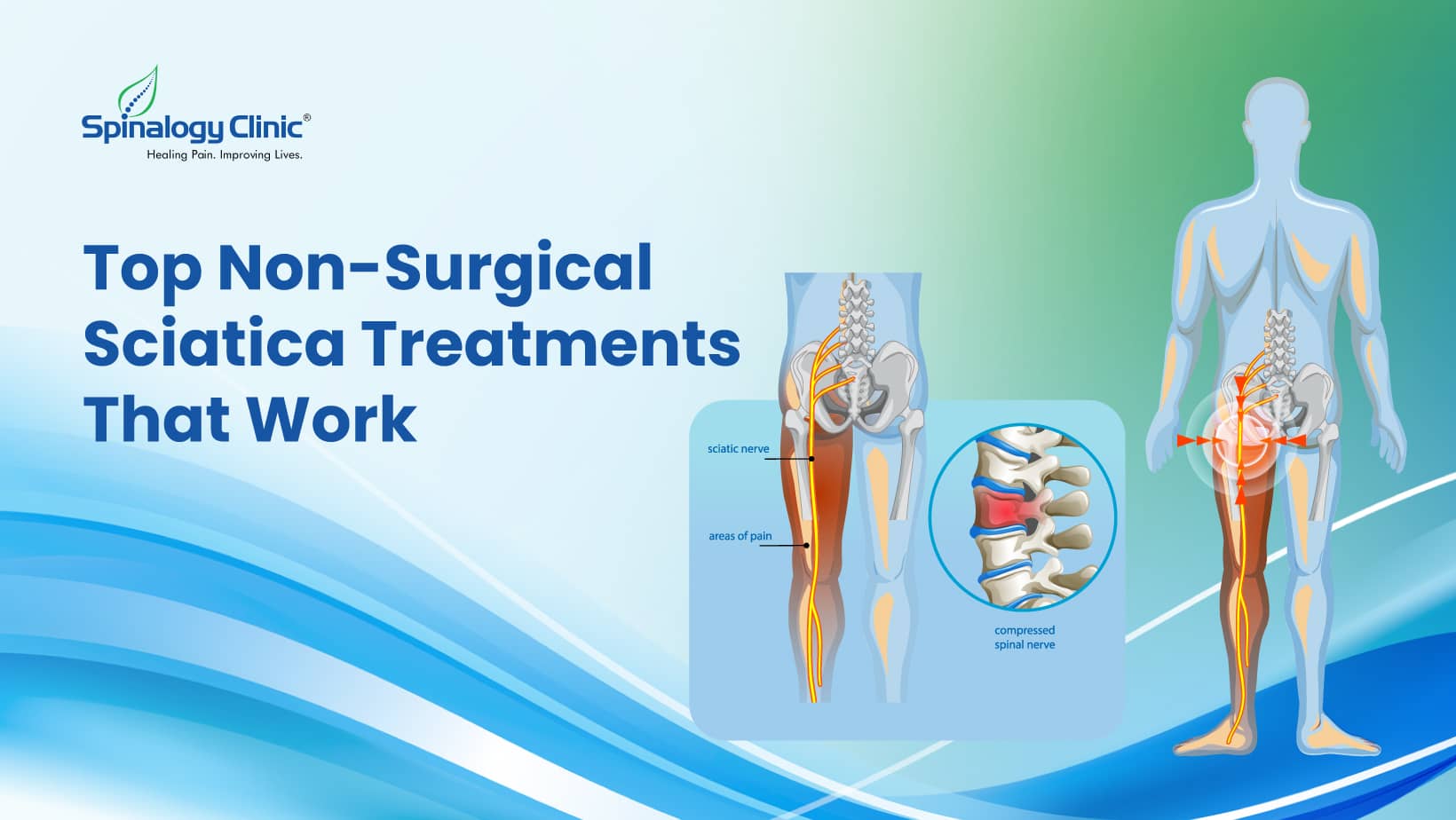 Top Non‑Surgical Sciatica Treatments That Works